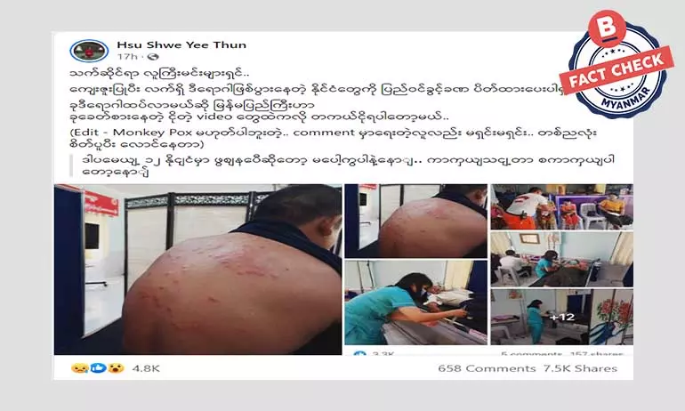 ဒီဖြစ်စဉ်က မျောက်ကျောက်ရောဂါမဟုတ်ပါ ဒီဖြစ်စဉ်က မျောက်ကျောက်ရောဂါမဟုတ်ပါ