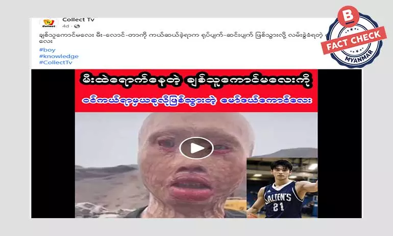 ချစ်သူကောင်မလေးကို ကယ်ရာမှ မီးလောင်ခံရပြီး ရုပ်ပျက်သွားတဲ့ ကောင်လေးဆိုတဲ့ သတင်းအမှား